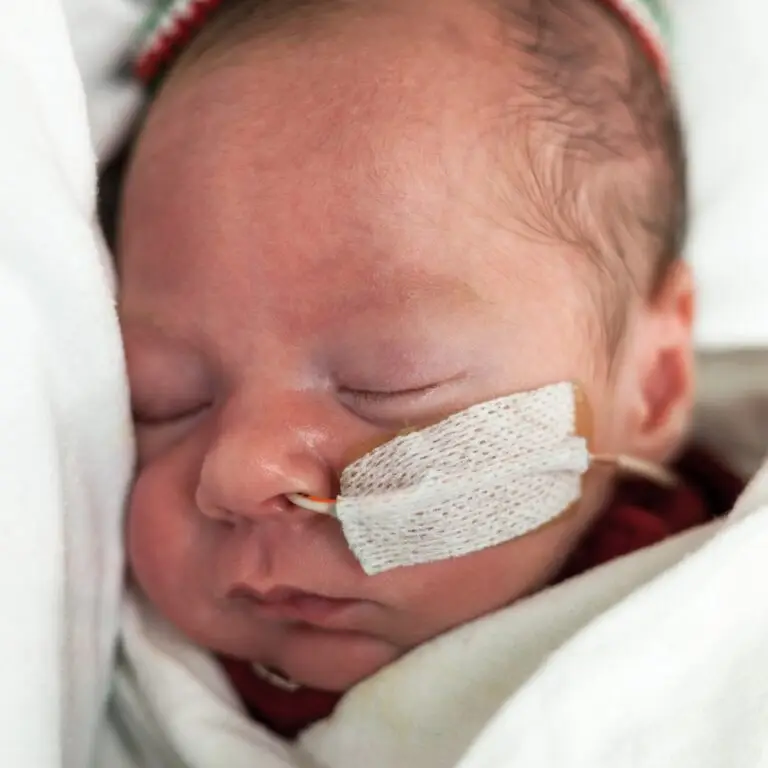 A baby with an NG Tube sleeping.